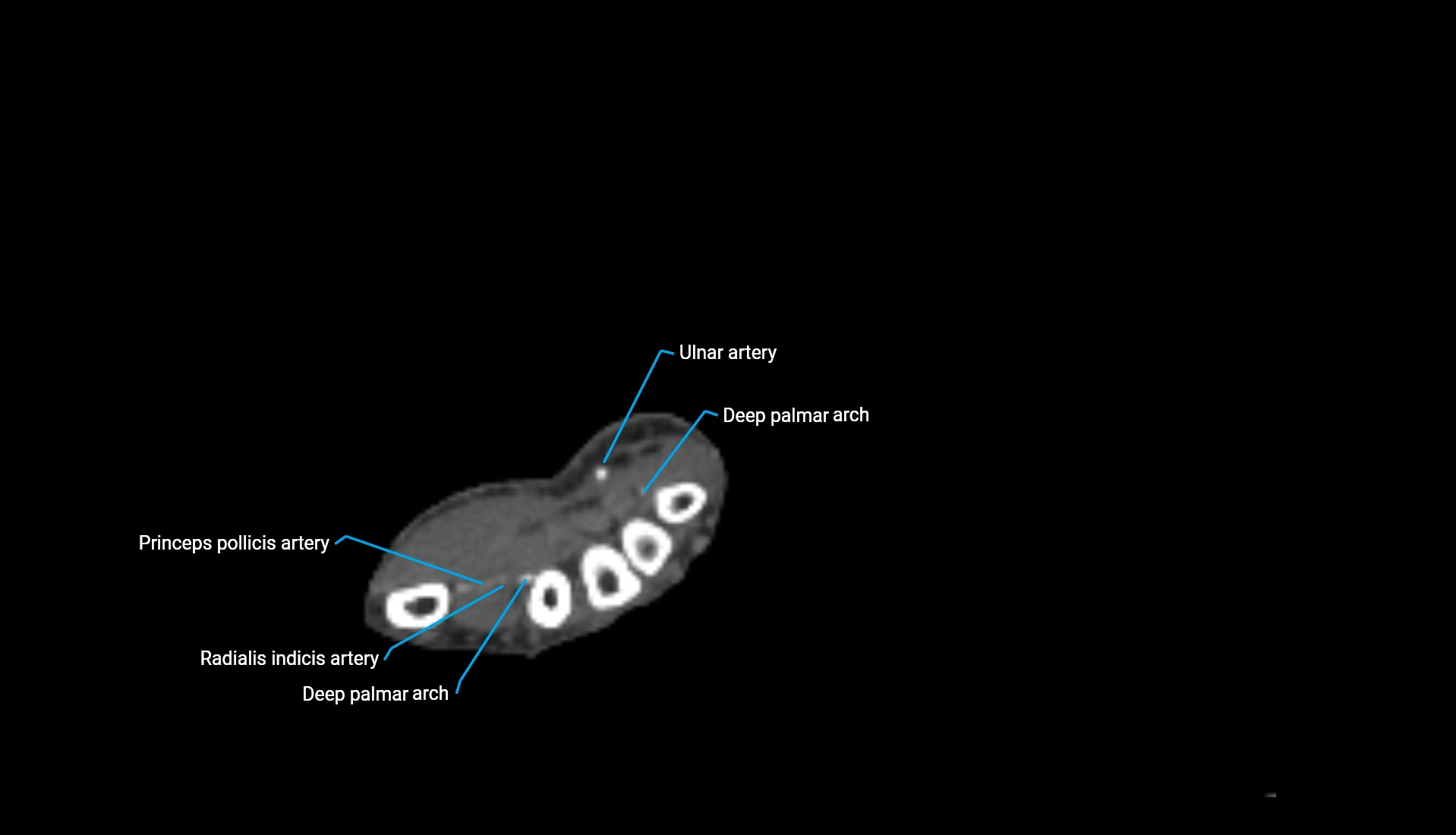 CTA upper limb axial cross sectional anatomy labelled image 65 (2).webp
